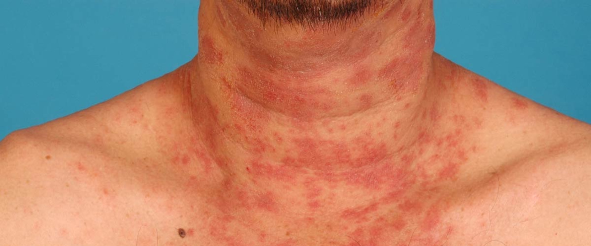 Eczema where do i sweat?