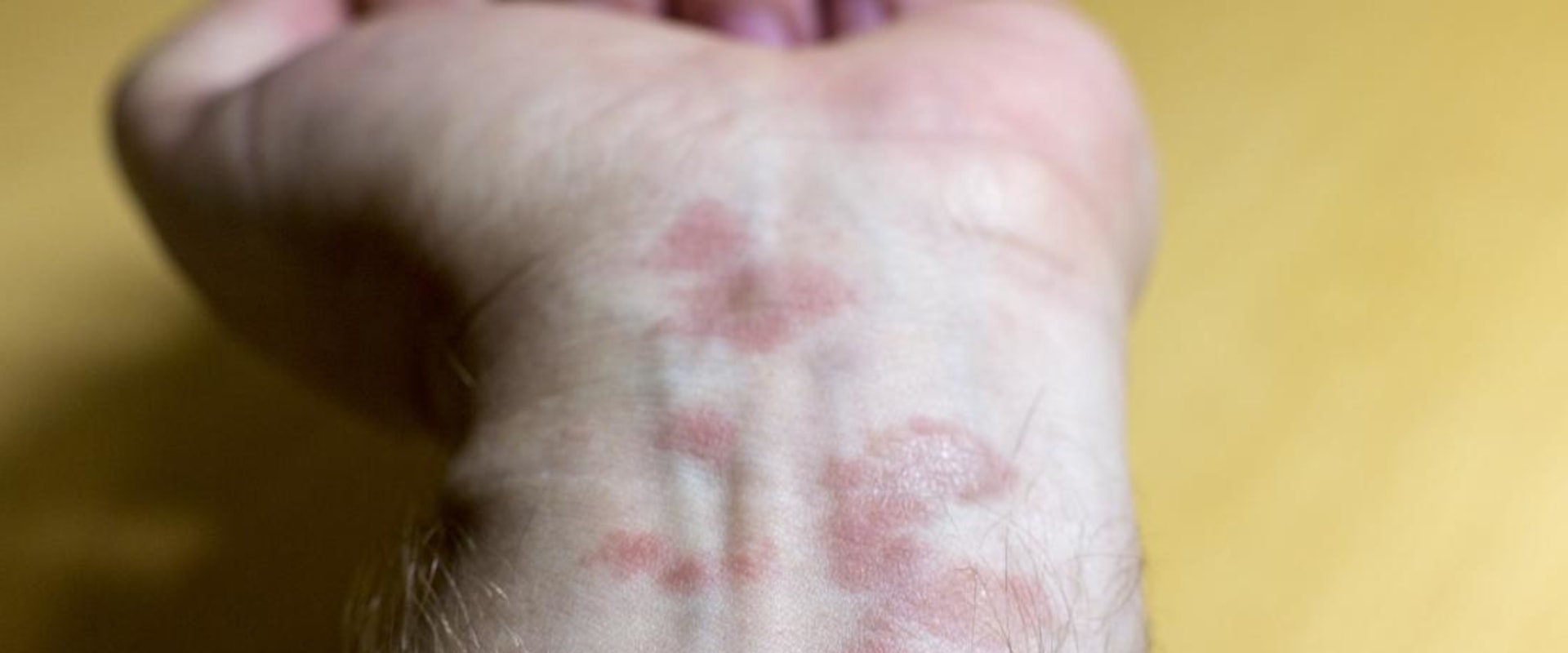 Can Eczema Spread Throughout the Body?