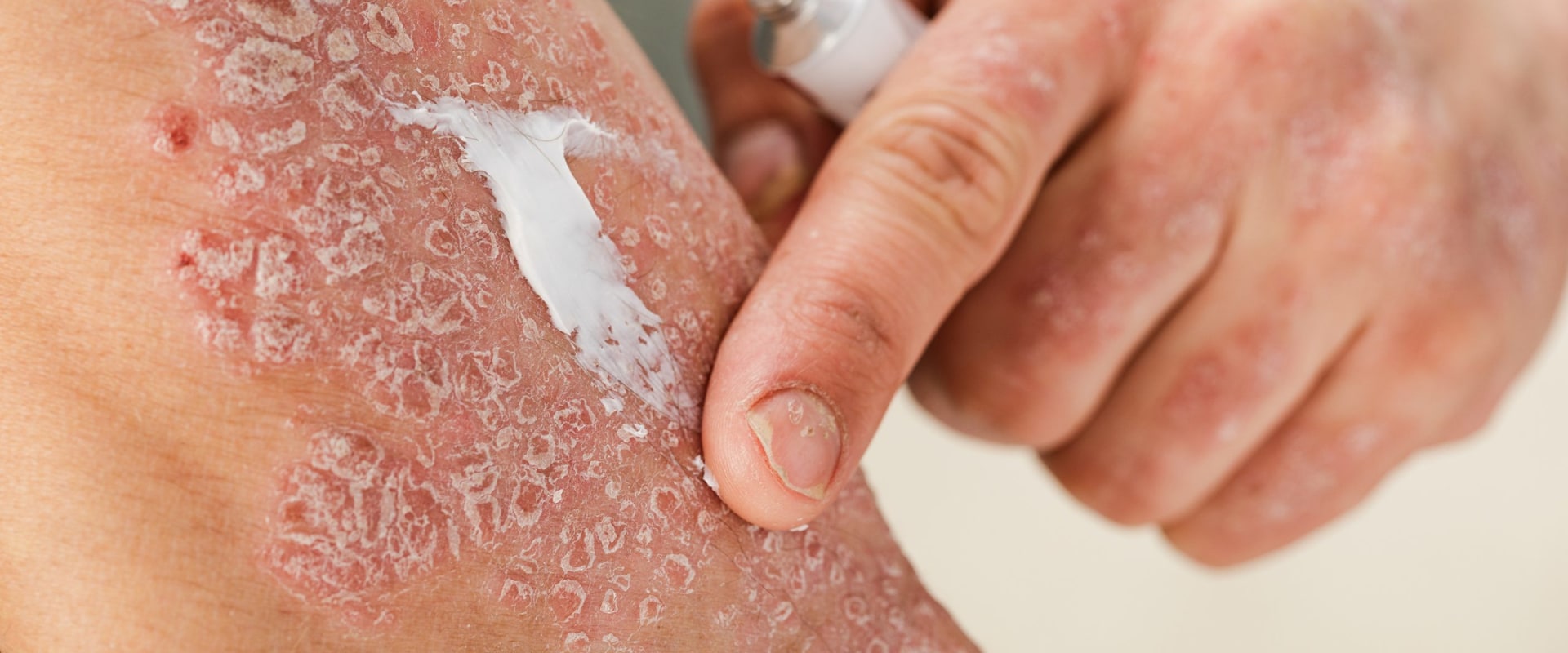 Is there a relationship between eczema and psoriasis?