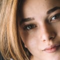 Can Eczema Cream Help Acne?