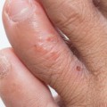 Will Eczema Disappear? An Expert's Perspective
