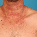 Sweating with Eczema: How to Exercise without Irritation
