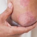 What Can Dermatitis Treatment Do For You?