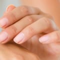 Treating Eczema: A Comprehensive Guide