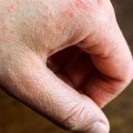 Does Dermatitis Disappear? An Expert's Perspective
