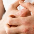 Who Diagnoses Eczema? An Expert's Guide