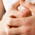 Who Diagnoses Eczema? An Expert's Guide