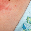 Eczema, Allergies, and Atopic Dermatitis: What's the Connection?