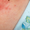 What are the Causes of Sudden Eczema Outbreaks?