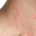 How to Prevent Eczema from Spreading Quickly