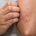 Understanding Eczema: When Does It Not Go Away?