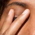 Understanding Eyelid Eczema: Causes, Symptoms, and Treatment