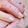 When Does Eczema Begin to Heal?