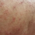 Can Eczema Scars Be Healed?