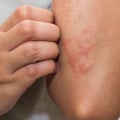 Understanding the Relationship between Eczema and Vitiligo