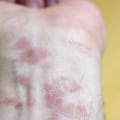 Can Eczema Spread Throughout the Body?