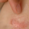 Are eczema and dermatitis the same thing?