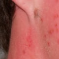 Can Eczema Spread? Understanding the Facts