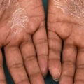 Understanding Hand Eczema: Causes, Symptoms and Treatment