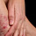What Diseases are Related to Eczema?