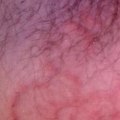 What Does Ringworm Eczema Look Like?