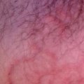 What Does Ringworm Eczema Look Like?