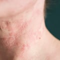 Treating Eczema: What You Need to Know