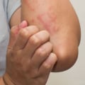 Do Dermatologists Treat Eczema? Expert Advice on Diagnosis, Treatment, and Follow-Up Care
