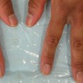 The Relationship between Vitiligo and Eczema