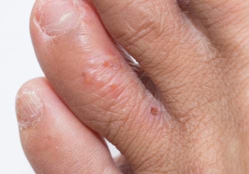 Will Eczema Disappear? An Expert's Perspective