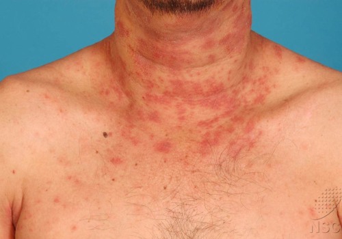 Sweating with Eczema: How to Exercise without Irritation