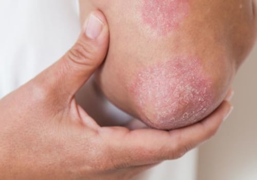 What Can Dermatitis Treatment Do For You?