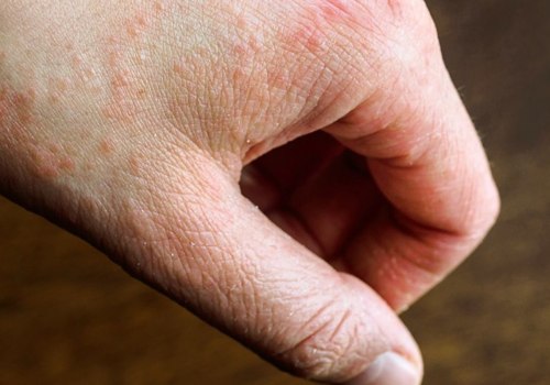 Does Dermatitis Disappear? An Expert's Perspective