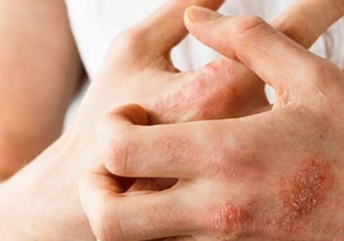 Who Diagnoses Eczema? An Expert's Guide