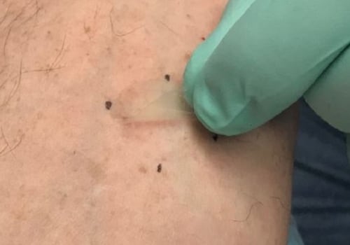 Identifying Eczema: A Comprehensive Guide