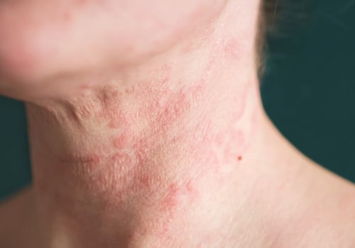 Everything You Need to Know About Eczema and Its Treatments
