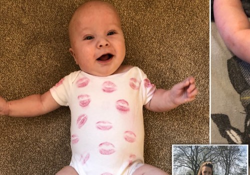 Will Eczema Go Away in Babies? - A Comprehensive Guide