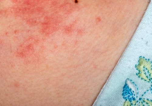 Eczema, Allergies, and Atopic Dermatitis: What's the Connection?