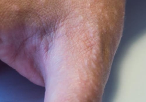 Does Eczema Cause White Spots? - A Comprehensive Guide