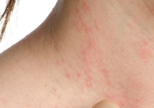 How to Prevent Eczema from Spreading Quickly
