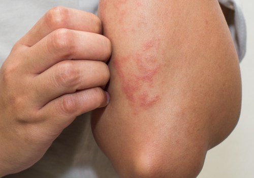 Understanding Eczema: When Does It Not Go Away?