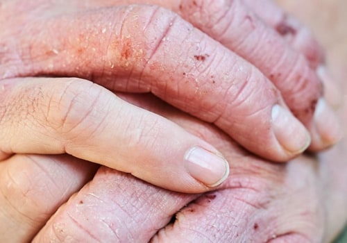 When Does Eczema Begin to Heal?