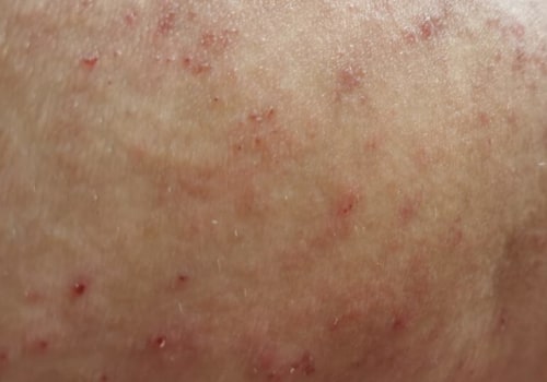 Can Eczema Scars Be Healed?