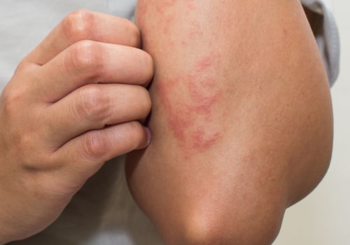 Understanding the Relationship between Eczema and Vitiligo