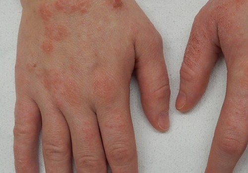 Eczema: Where to Rub Your Clothes Right