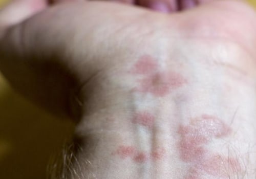 Can Eczema Spread Throughout the Body?