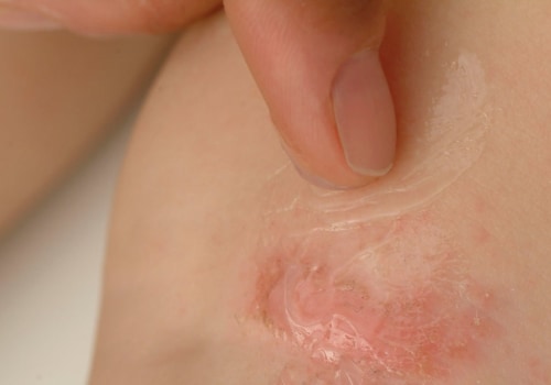 Are eczema and dermatitis the same thing?