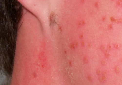 Can Eczema Spread? Understanding the Facts