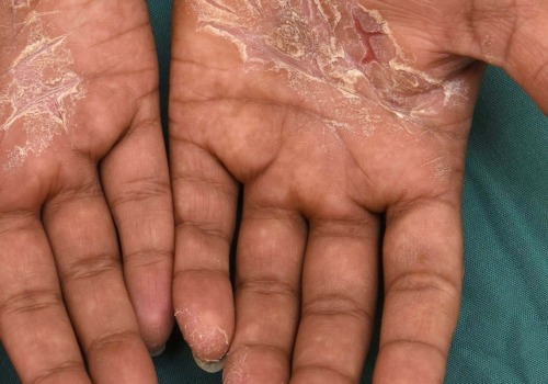 Understanding Hand Eczema: Causes, Symptoms and Treatment