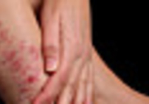 What Diseases are Related to Eczema?